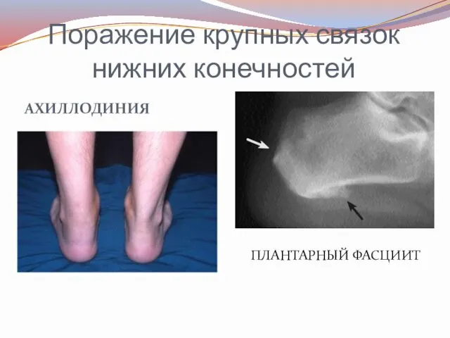 Поражение крупных связок нижних конечностей АХИЛЛОДИНИЯ ПЛАНТАРНЫЙ ФАСЦИИТ