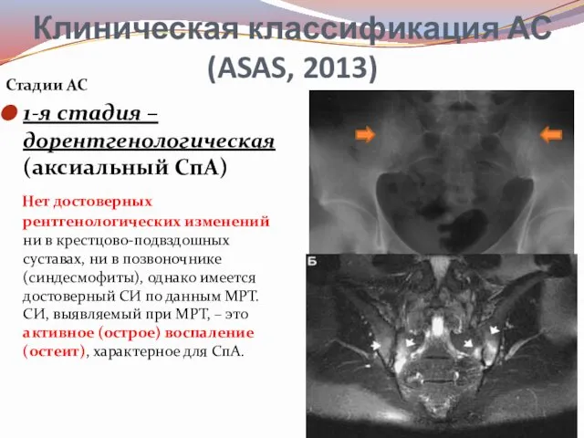 Клиническая классификация АС (ASAS, 2013) Стадии АС 1-я стадия –дорентгенологическая (аксиальный