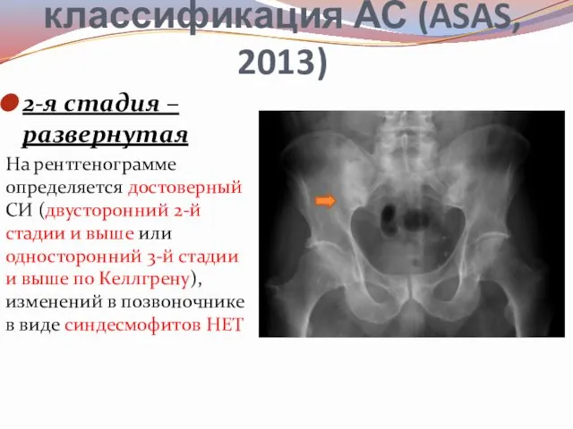 Клиническая классификация АС (ASAS, 2013) 2-я стадия – развернутая На рентгенограмме