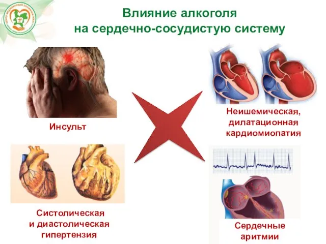 Влияние алкоголя на сердечно-сосудистую систему Систолическая и диастолическая гипертензия Инсульт Сердечные аритмии Неишемическая, дилатационная кардиомиопатия