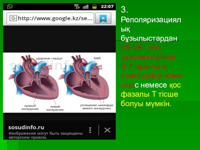 3. Реполяризациялық бұзылыстардан V5-V6 I aVL тіркемелерінде S-T аралығы төмендейді және