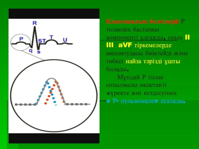 Классикалық белгілері: Р тісшенің бастапқы компоненті ұлғаяды, оның II III aVF