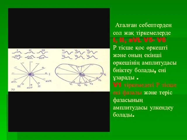 Аталған себептерден сол жақ тіркемелерде I, II, aVL V5- V6 Р