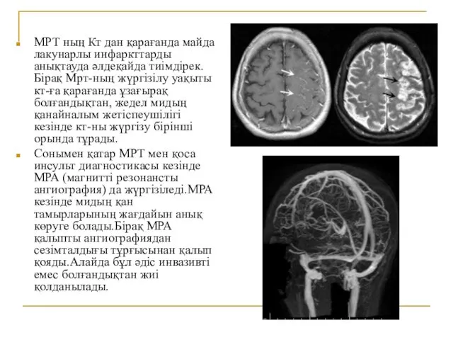 МРТ ның Кт дан қарағанда майда лакунарлы инфаркттарды анықтауда әлдеқайда тиімдірек.Бірақ