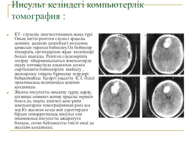 Инсульт кезіндегі компьютерлік томография : КТ- сәулелік диагностиканың жаңа түрі.Оның негізі-рентген