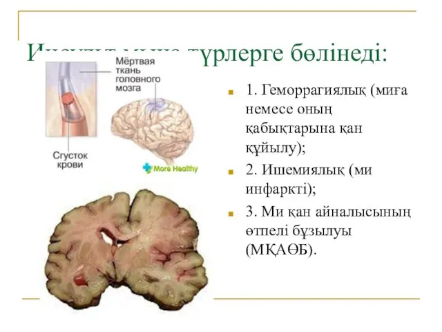 Инсульт мына түрлерге бөлінеді: 1. Геморрагиялық (миға немесе оның қабықтарына қан