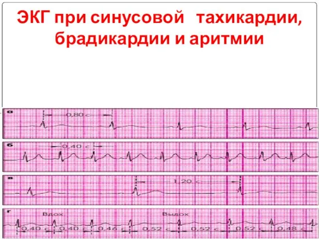 ЭКГ при синусовой тахикардии, брадикардии и аритмии