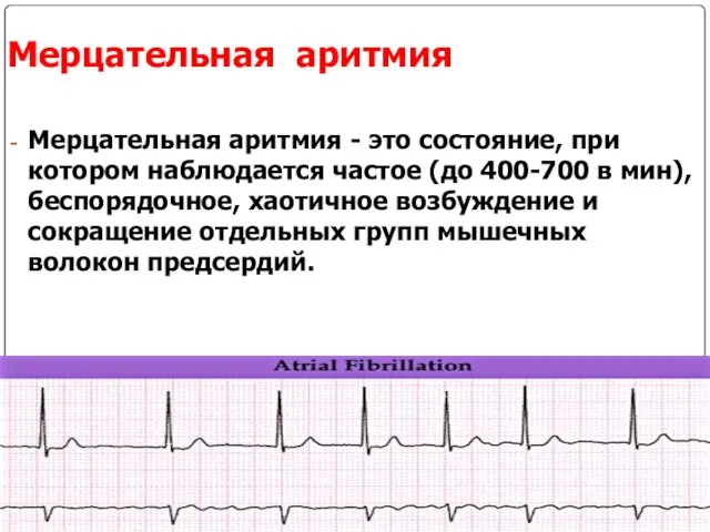 Мерцательная аритмия Мерцательная аритмия - это состояние, при котором наблюдается частое