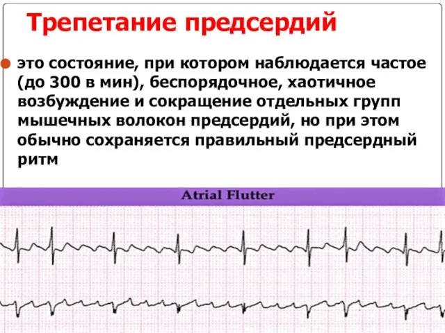 Трепетание предсердий это состояние, при котором наблюдается частое (до 300 в