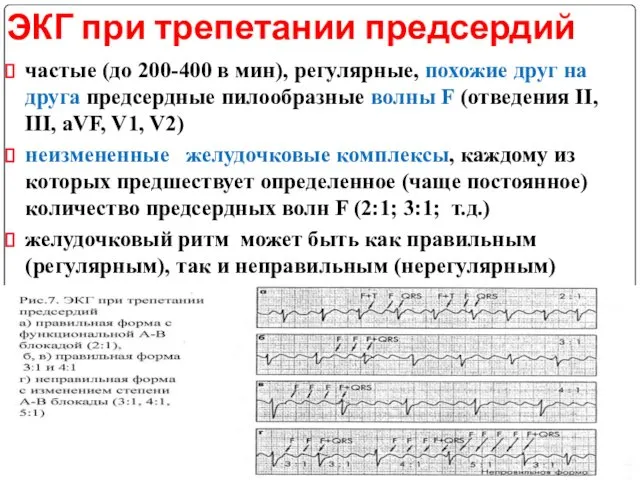 ЭКГ при трепетании предсердий частые (до 200-400 в мин), регулярные, похожие