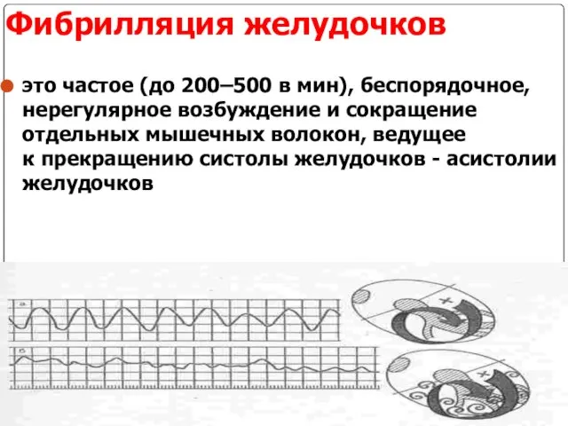 Фибрилляция желудочков это частое (до 200–500 в мин), беспорядочное, нерегулярное возбуждение