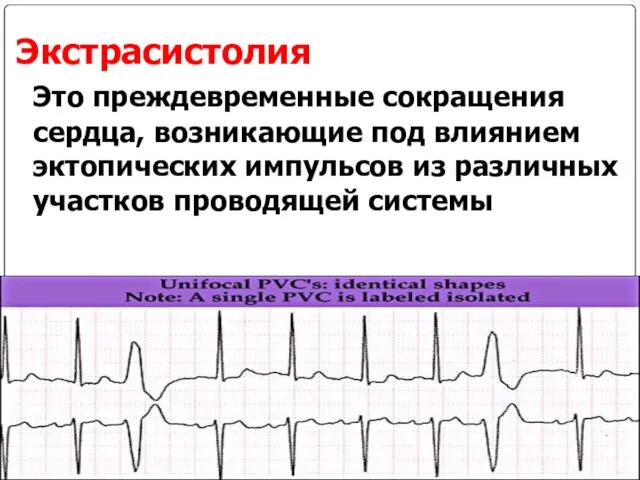 Экстрасистолия Это преждевременные сокращения сердца, возникающие под влиянием эктопических импульсов из различных участков проводящей системы