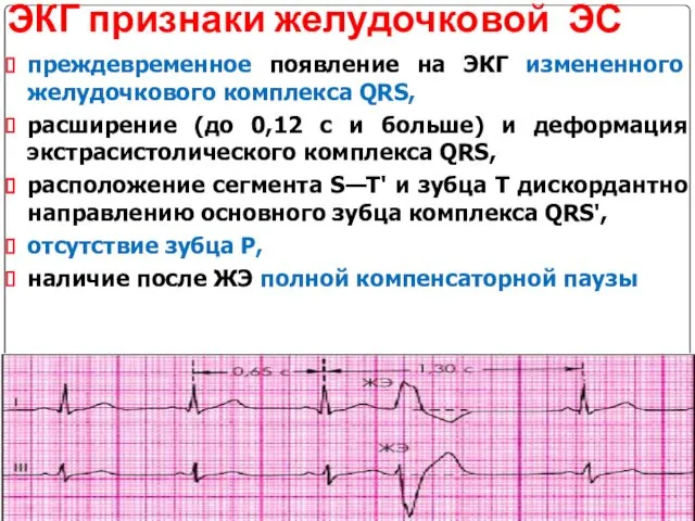 ЭКГ признаки желудочковой ЭС преждевременное появление на ЭКГ измененного желудочкового комплекса