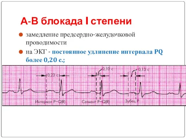 А-В блокада I степени замедление предсердно-желудочковой проводимости на ЭКГ - постоянное