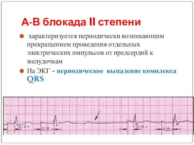 А-В блокада II степени характеризуется периодически возникающим прекращением проведения отдельных электрических