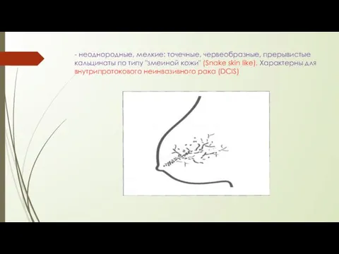 - неоднородные, мелкие: точечные, червеобразные, прерывистые кальцинаты по типу "змеиной кожи"