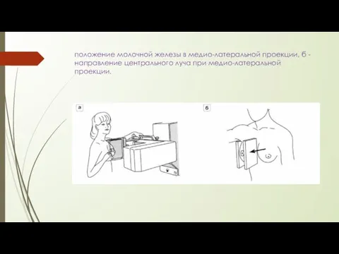 положение молочной железы в медио-латеральной проекции, б - направление центрального луча при медио-латеральной проекции.