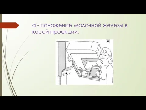 а - положение молочной железы в косой проекции.