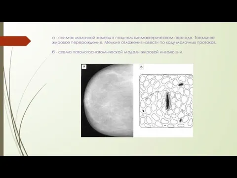 а - снимок молочной железы в позднем климактерическом периоде. Тотальное жировое