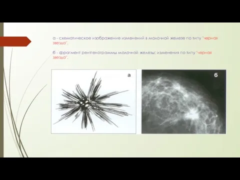 а - схематическое изображение изменений в молочной железе по типу "черная