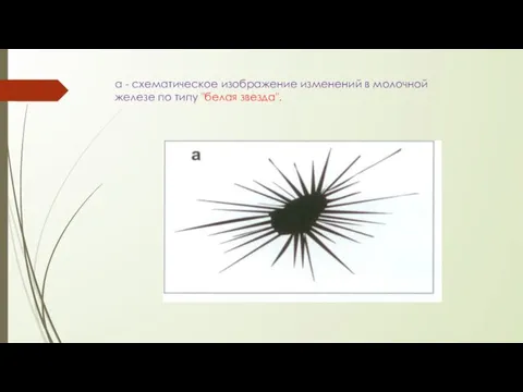 а - схематическое изображение изменений в молочной железе по типу "белая звезда".