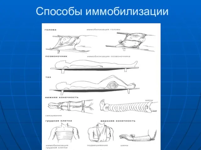 Способы иммобилизации