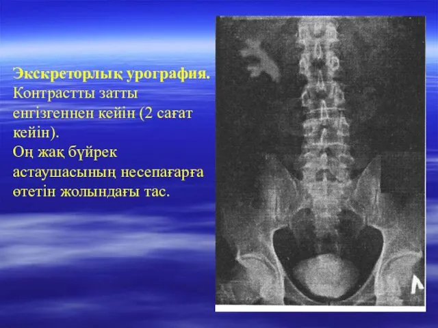 Экскреторлық урография. Контрастты затты енгізгеннен кейін (2 сағат кейін). Оң жақ