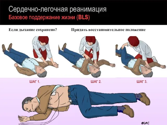 Сердечно-легочная реанимация Базовое поддержание жизни (BLS) Если дыхание сохранено? Придать восстановительное положение