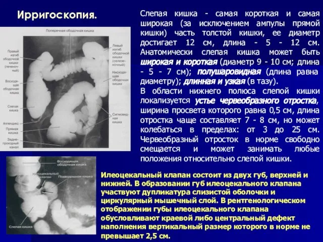 Ирригоскопия. Слепая кишка - самая короткая и самая широкая (за исключением