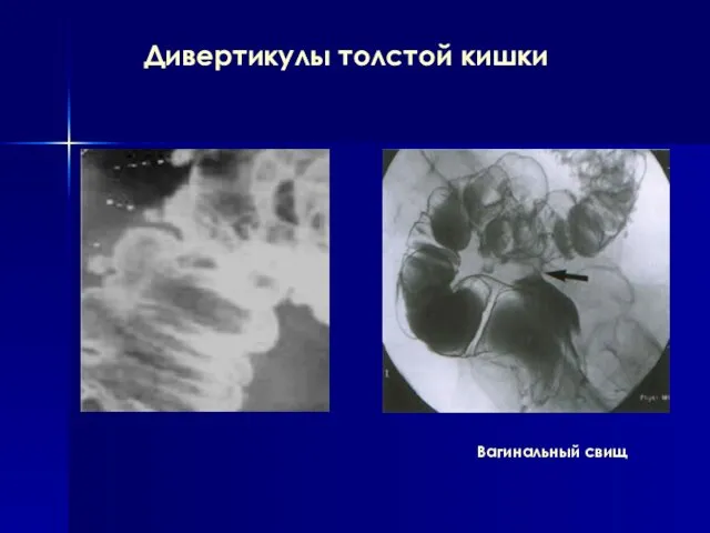 Дивертикулы толстой кишки Вагинальный свищ