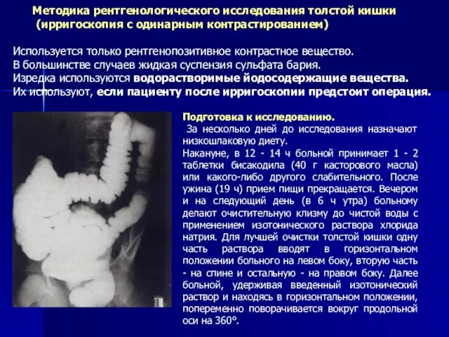 Методика рентгенологического исследования толстой кишки (ирригоскопия с одинарным контрастированием) Используется только