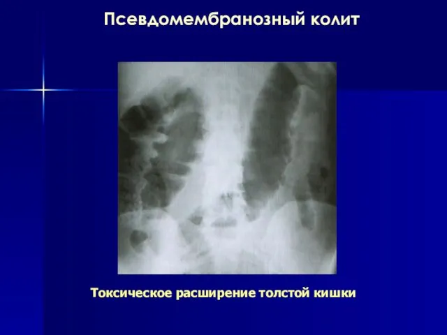 Псевдомембранозный колит Токсическое расширение толстой кишки