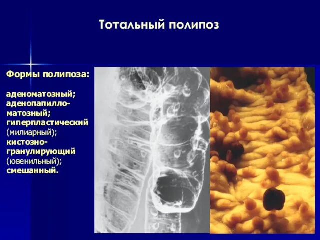 Тотальный полипоз Формы полипоза: аденоматозный; аденопапилло-матозный; гиперпластический (милиарный); кистозно-гранулирующий (ювенильный); смешанный.