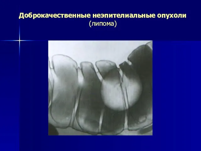 Доброкачественные неэпителиальные опухоли (липома)