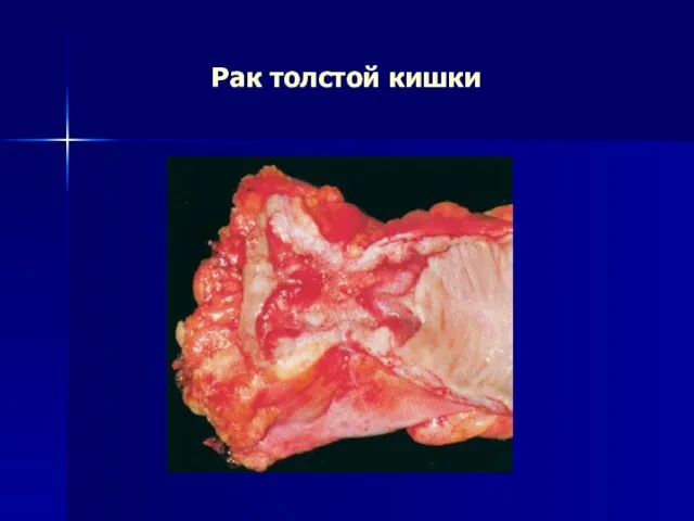 Рак толстой кишки