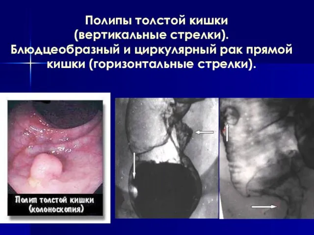 Полипы толстой кишки (вертикальные стрелки). Блюдцеобразный и циркулярный рак прямой кишки (горизонтальные стрелки).