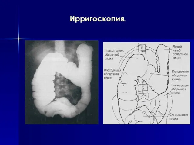 Ирригоскопия.