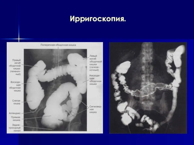 Ирригоскопия.