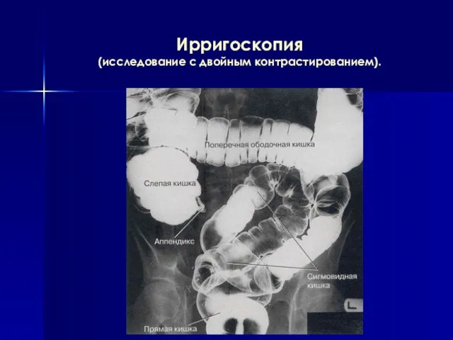 Ирригоскопия (исследование с двойным контрастированием).