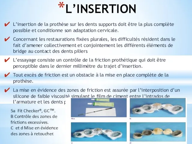 L’INSERTION L’insertion de la prothèse sur les dents supports doit être