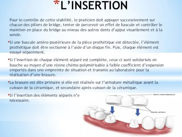 L’INSERTION Pour le contrôle de cette stabilité, le praticien doit appuyer