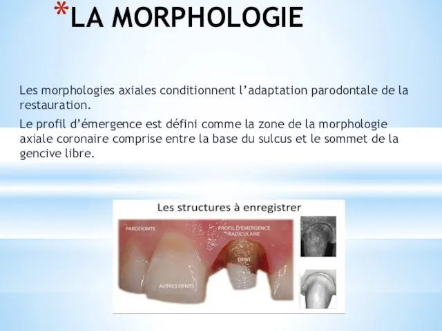 LA MORPHOLOGIE Les morphologies axiales conditionnent l’adaptation parodontale de la restauration.