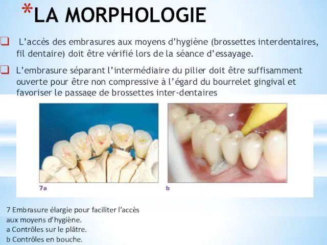 LA MORPHOLOGIE L’accès des embrasures aux moyens d’hygiène (brossettes interdentaires, fil