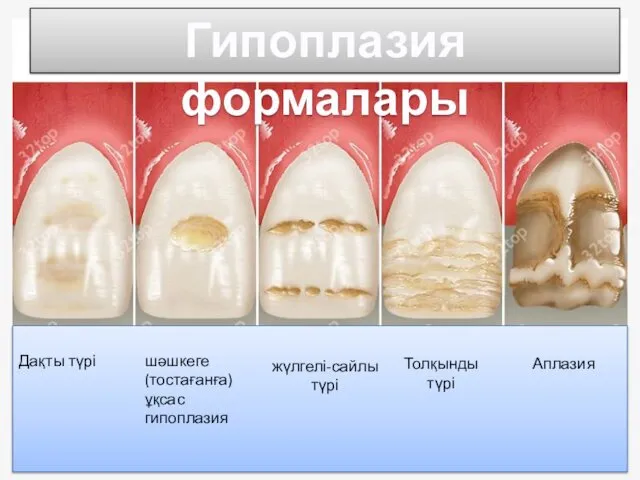 Дақты түрі Толқынды түрі Аплазия жүлгелі-сайлы түрі шәшкеге (тостағанға) ұқсас гипоплазия Гипоплазия формалары