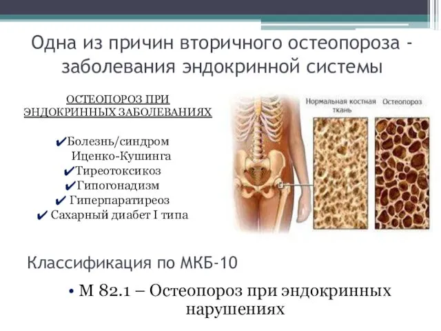 Одна из причин вторичного остеопороза - заболевания эндокринной системы М 82.1