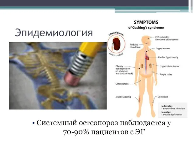 Эпидемиология Системный остеопороз наблюдается у 70-90% пациентов с ЭГ