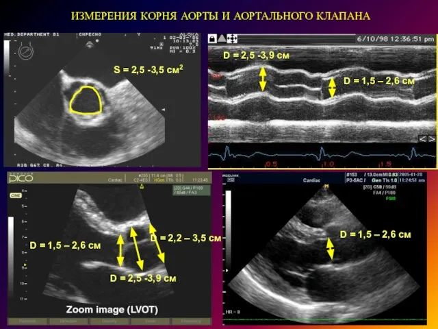 ИЗМЕРЕНИЯ КОРНЯ АОРТЫ И АОРТАЛЬНОГО КЛАПАНА S = 2,5 -3,5 см2