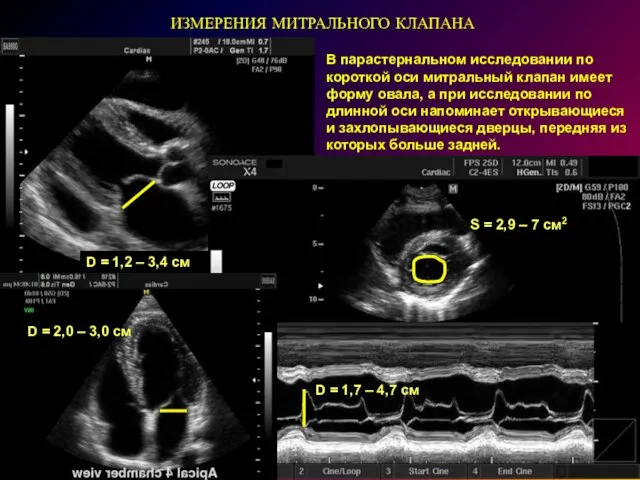 ИЗМЕРЕНИЯ МИТРАЛЬНОГО КЛАПАНА В парастернальном исследовании по короткой оси митральный клапан