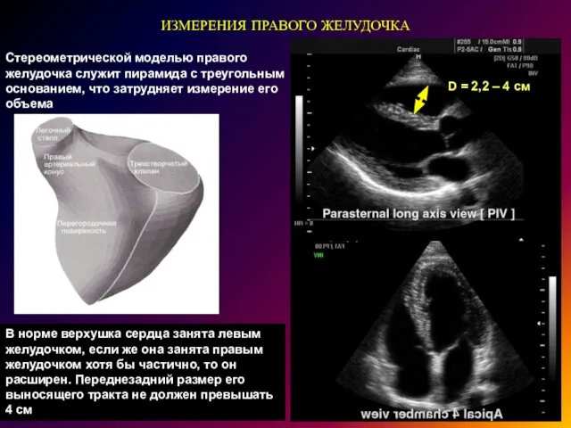 ИЗМЕРЕНИЯ ПРАВОГО ЖЕЛУДОЧКА D = 2,2 – 4 см Стереометрической моделью