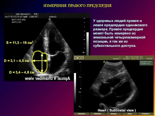 ИЗМЕРЕНИЯ ПРАВОГО ПРЕДСЕРДИЯ D = 3,4 – 4,8 см D =